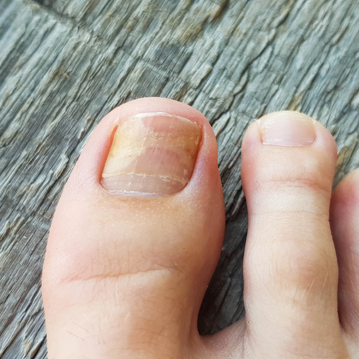 Ideal candidate for Onychomycosis (Fungal Infection of the Nails) clinical study in New York