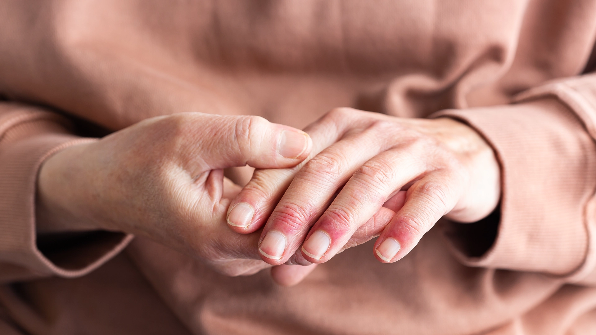 Eczema clinical trial in Bowling Green, Kentucky, New York City, and Bronx